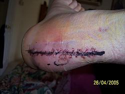 Foot surgery-wound2.jpg